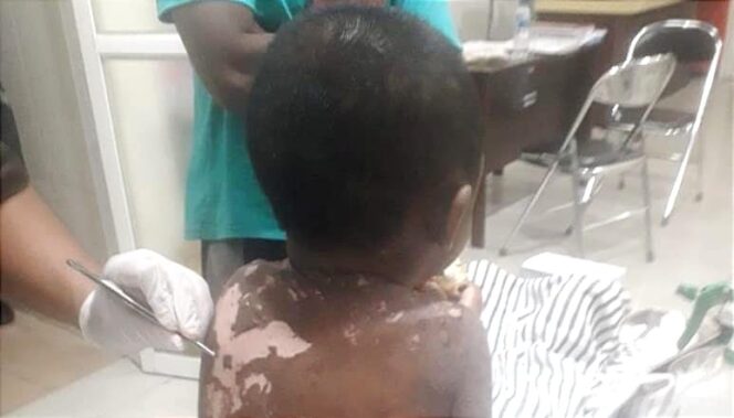 
					Miris! Anak 6 Tahun Jadi Korban Aniaya Orang Tua, Kulit Melepuh