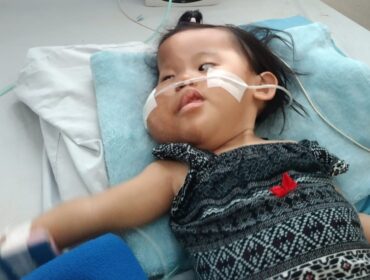 BUTUH BANTUAN: Elena Najma Azkayla, warga Desa Bago, Kecamatan Besuk, Kabupaten Probolinggo, didiagnosa menderita Sindrom Proteus. (foto: istimewa)
