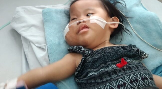 BUTUH BANTUAN: Elena Najma Azkayla, warga Desa Bago, Kecamatan Besuk, Kabupaten Probolinggo, didiagnosa menderita Sindrom Proteus. (foto: istimewa)

