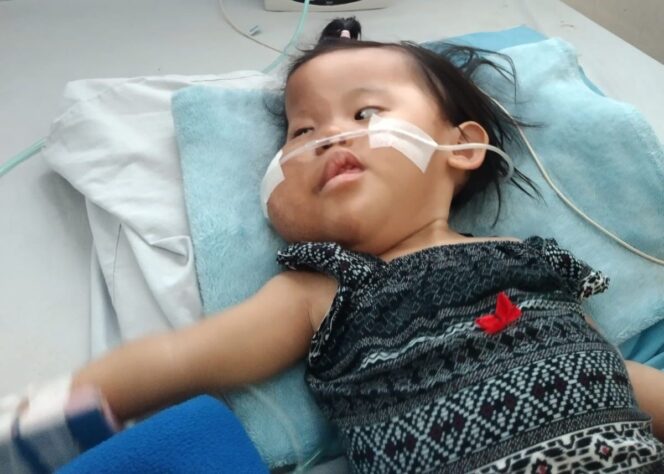 
					BUTUH BANTUAN: Elena Najma Azkayla, warga Desa Bago, Kecamatan Besuk, Kabupaten Probolinggo, didiagnosa menderita Sindrom Proteus. (foto: istimewa)

